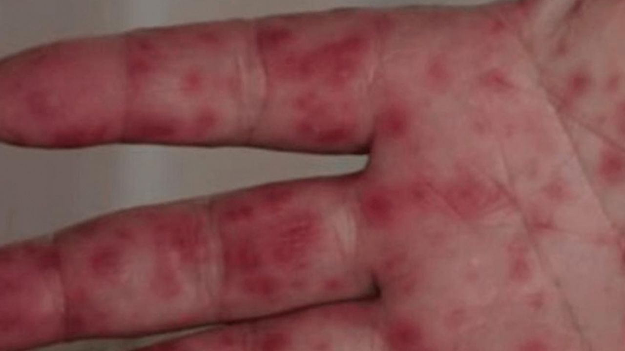 Covid ve maymun çiçeğinden sonra yeni bir salgın daha: Domates gribi